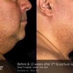 sherwood park chin contouring