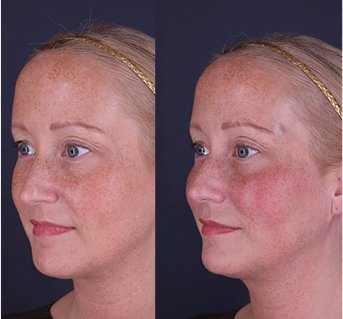 Cheeks botox edmonton