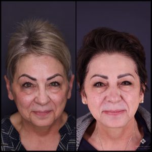 Edmonton hydrafacial