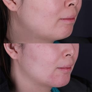 Chin botox edmonton