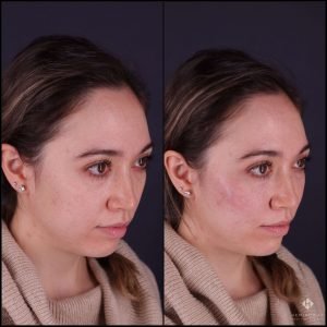 hydrafacial Sherwood Park