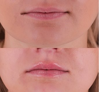 Edmonton botox lips