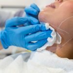 chin contour belkyra