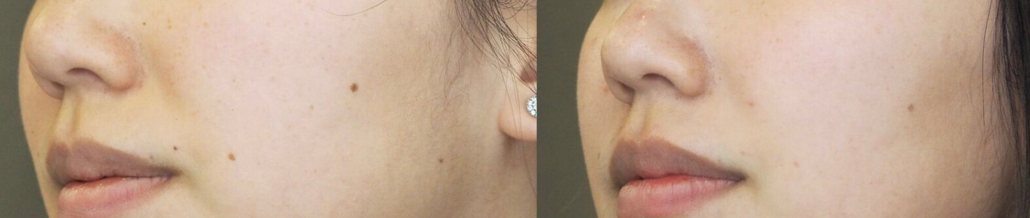 pigmented-lesions (1)